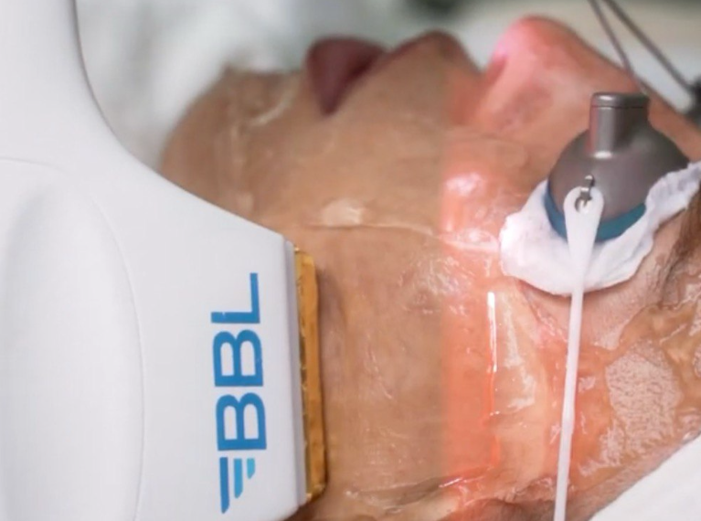 bbl heroic phototherapy